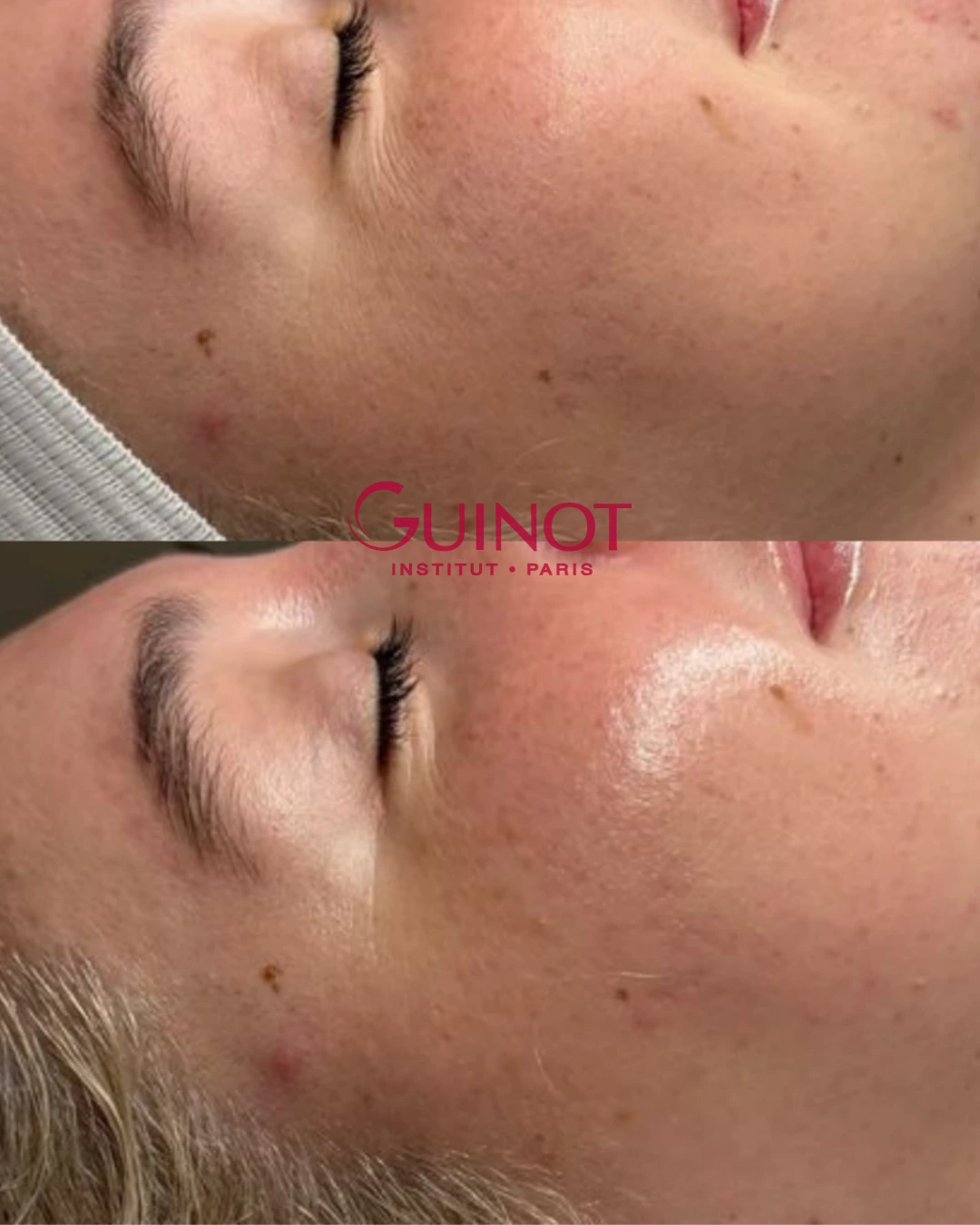 Vorher-Nachher Ergebnis Gesichtsbehandlung Guinot Berlin