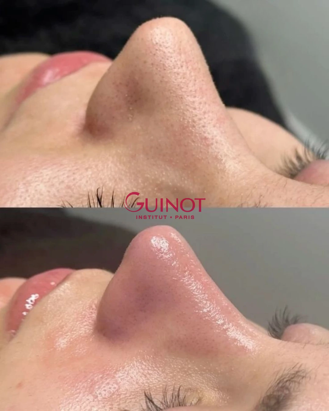 Vorher-Nachher Ergebnis Aknebehandlung Guinot Berlin