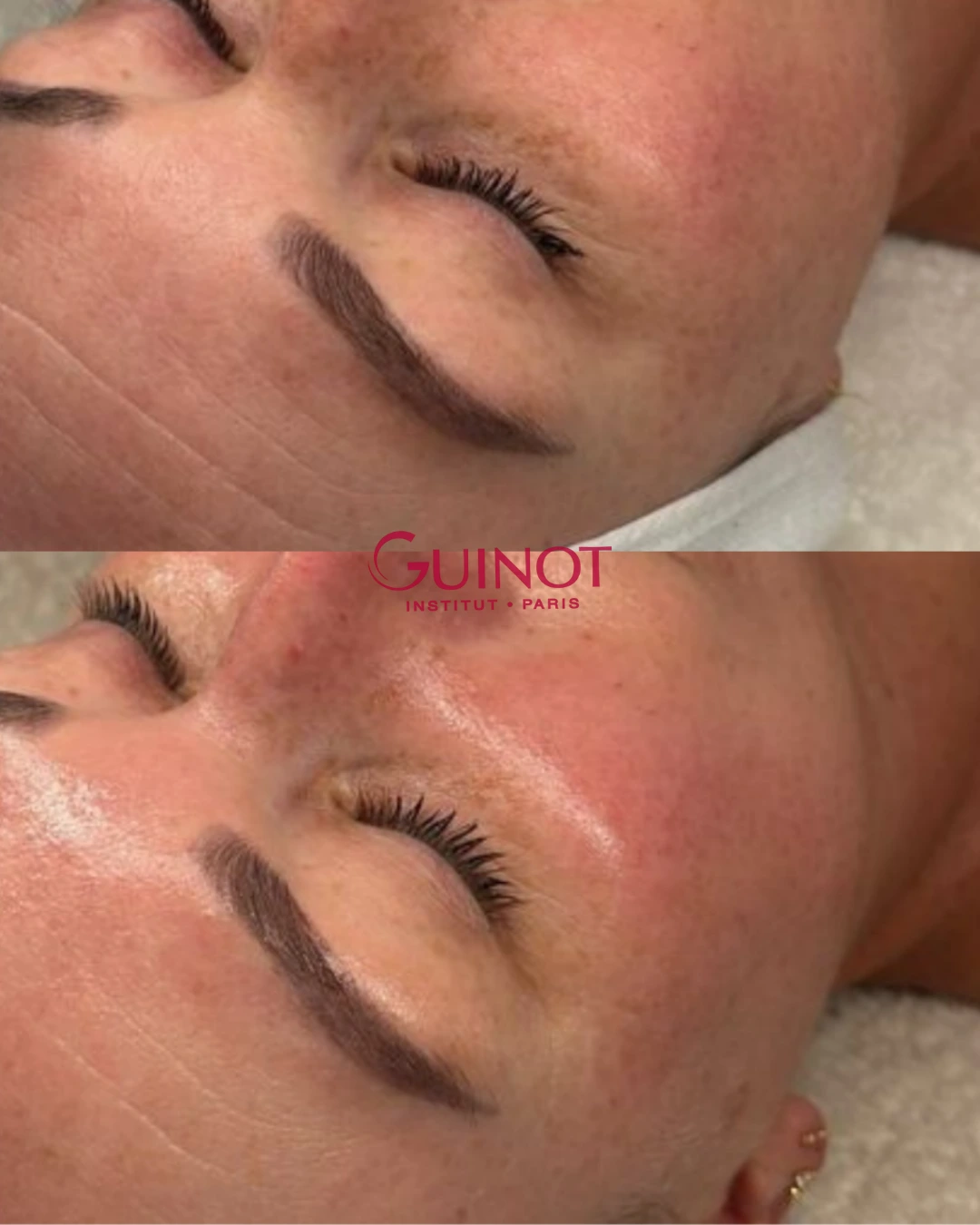 Vorher-Nachher Ergebnis Porenverfeinerung Guinot Berlin