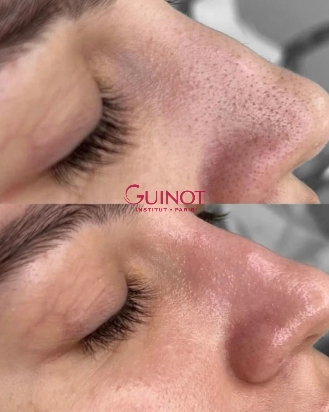 Vorher-Nachher Ergebnis Rötungen Guinot Berlin