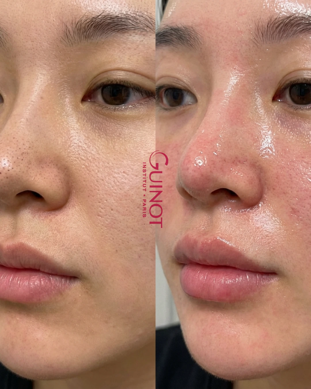 Vorher-Nachher Ergebnis Hautverfeinerung Guinot Berlin