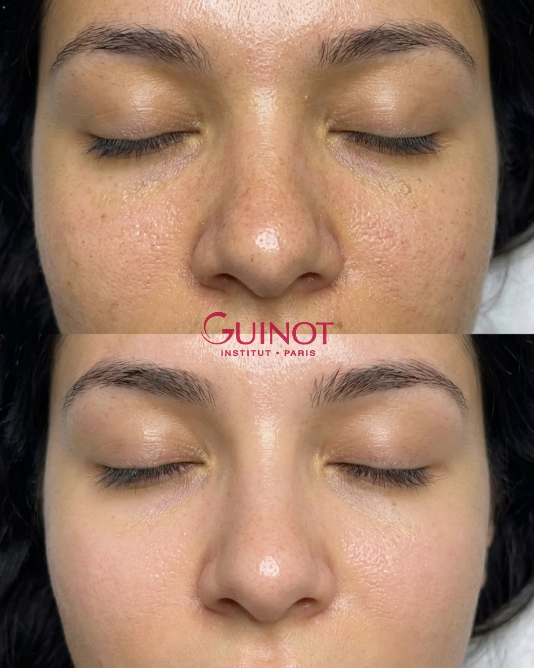 Vorher-Nachher Ergebnis Gesichtsprofil Guinot Berlin