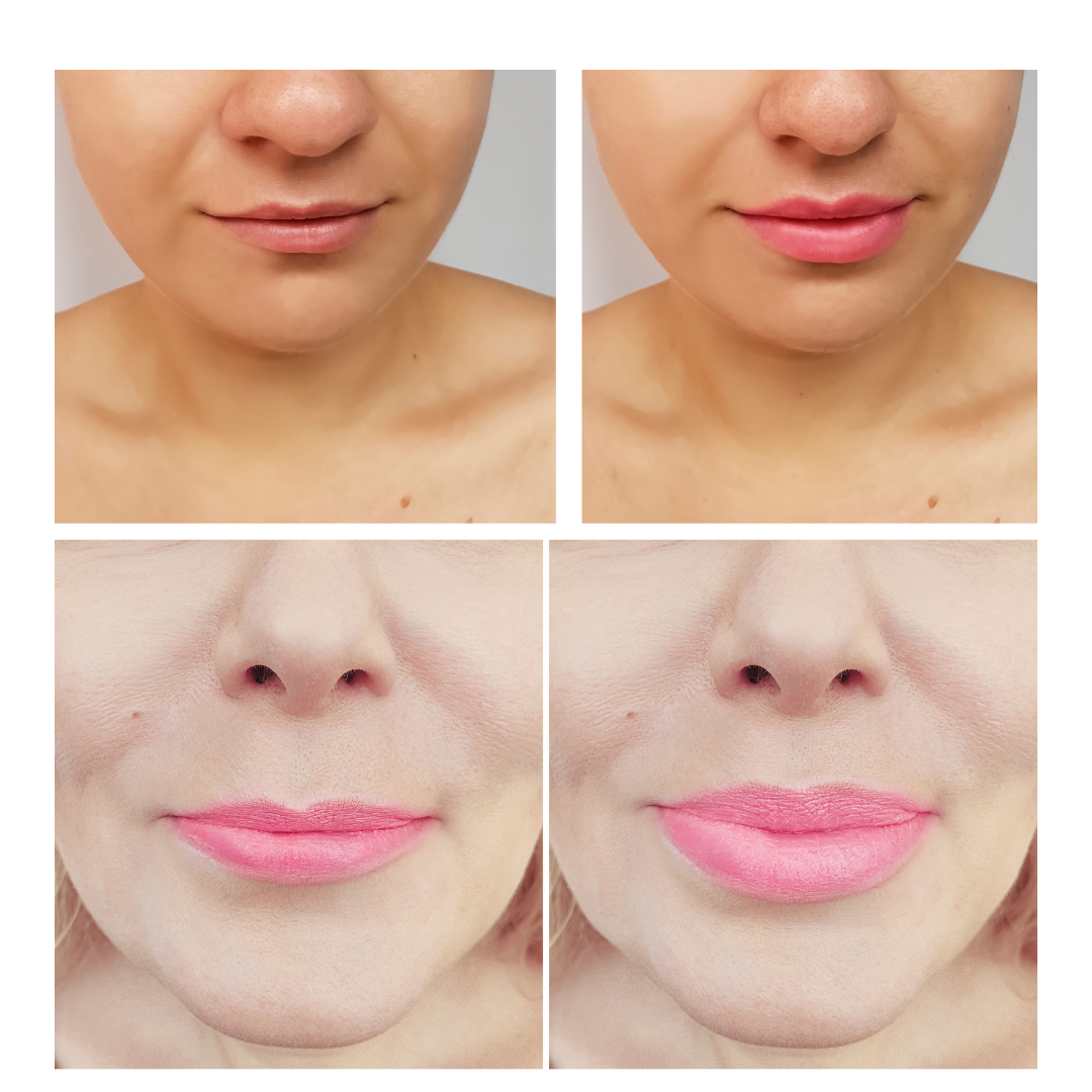 Lippen Behandlung Vorher-Nachher Kosmetikstudio Berlin